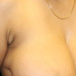 Axillary Breast Tissue – Removal Before & After Patient #29396