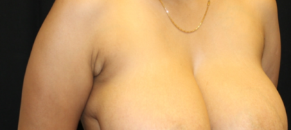 Axillary Breast Tissue – Removal Before & After Patient #29396