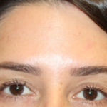 Botox and Dysport Before & After Patient #29343