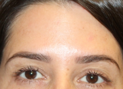 Botox and Dysport Before & After Patient #29343