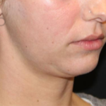 Kybella Before & After Patient #29328