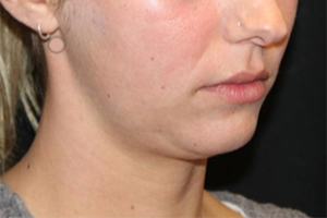 Kybella Before & After Patient #29328