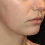 Kybella Before & After Patient #29328