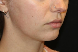 Kybella Before & After Patient #29328