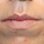 Lip Filler Before & After Patient #29334