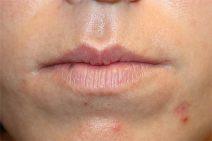 Lip Filler Before & After Patient #29334