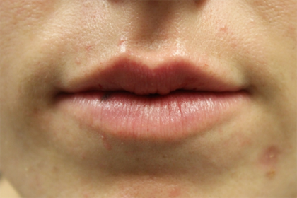 Lip Filler Before & After Patient #29334