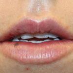 Lip Filler Before & After Patient #29334