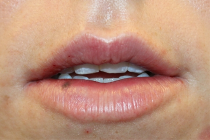 Lip Filler Before & After Patient #29334