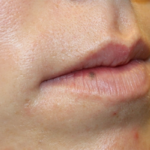 Lip Filler Before & After Patient #29334