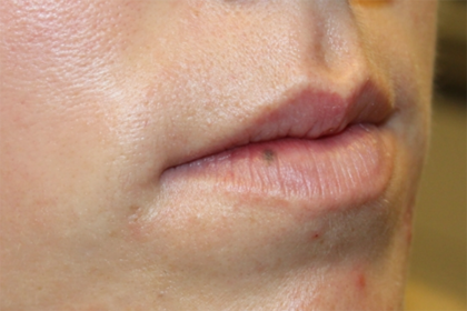 Lip Filler Before & After Patient #29334