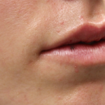 Lip Filler Before & After Patient #29334