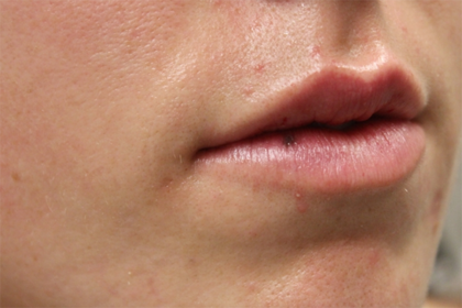 Lip Filler Before & After Patient #29334