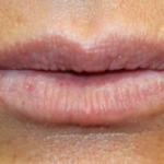 Lip Filler Before & After Patient #29351