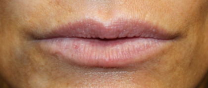 Lip Filler Before & After Patient #29351