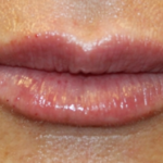 Lip Filler Before & After Patient #29351