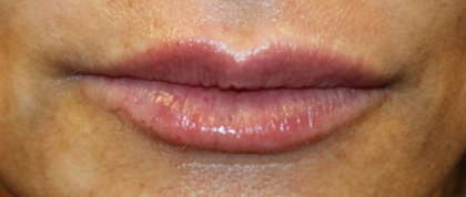 Lip Filler Before & After Patient #29351