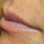 Lip Filler Before & After Patient #29351