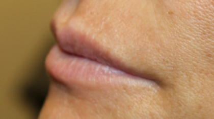 Lip Filler Before & After Patient #29351