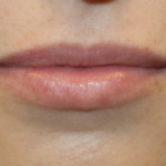 Lip Filler Before & After Patient #29356