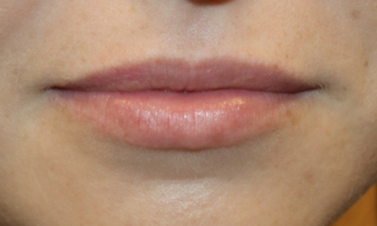 Lip Filler Before & After Patient #29356