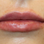 Lip Filler Before & After Patient #29356