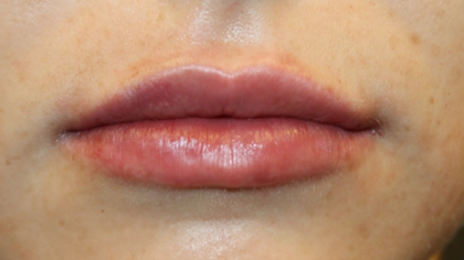 Lip Filler Before & After Patient #29356