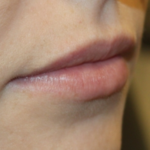 Lip Filler Before & After Patient #29356