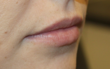 Lip Filler Before & After Patient #29356