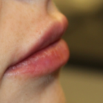 Lip Filler Before & After Patient #29356