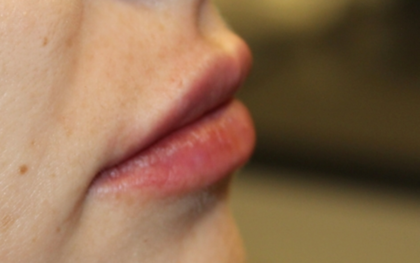 Lip Filler Before & After Patient #29356