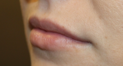 Lip Filler Before & After Patient #29356