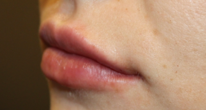 Lip Filler Before & After Patient #29356