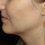 Kybella Before & After Patient #29434