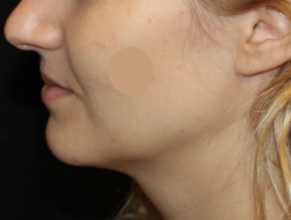 Kybella Before & After Patient #29434