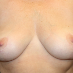 Breast Lift Before & After Patient #29444