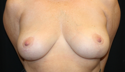 Breast Lift Before & After Patient #29444