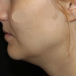 Kybella Before & After Patient #29434