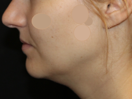 Kybella Before & After Patient #29434