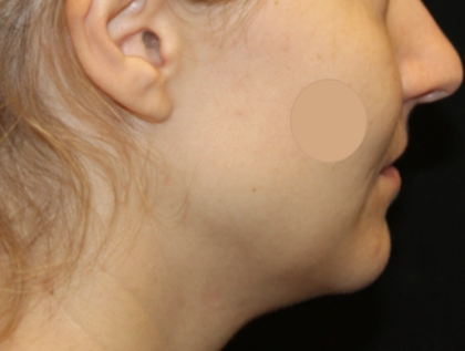 Kybella Before & After Patient #29434