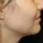 Kybella Before & After Patient #29434