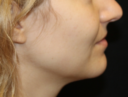 Kybella Before & After Patient #29434