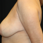 Breast Lift Before & After Patient #29444