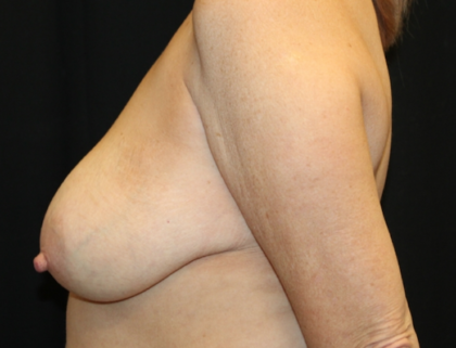 Breast Lift Before & After Patient #29444