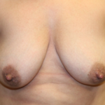 Breast Augmentation - Shaped Silicone Implants Before & After Patient #29439