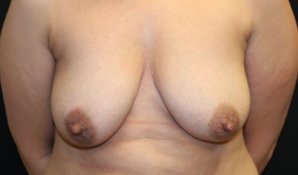 Breast Augmentation - Shaped Silicone Implants Before & After Patient #29439