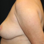 Breast Lift Before & After Patient #29444