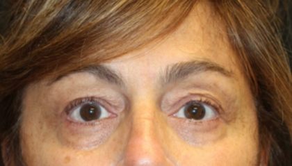 Blepharoplasty Before & After Patient #29451