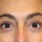 Blepharoplasty Before & After Patient #29451