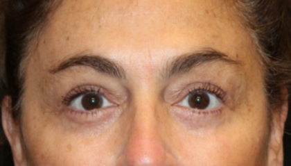 Blepharoplasty Before & After Patient #29451